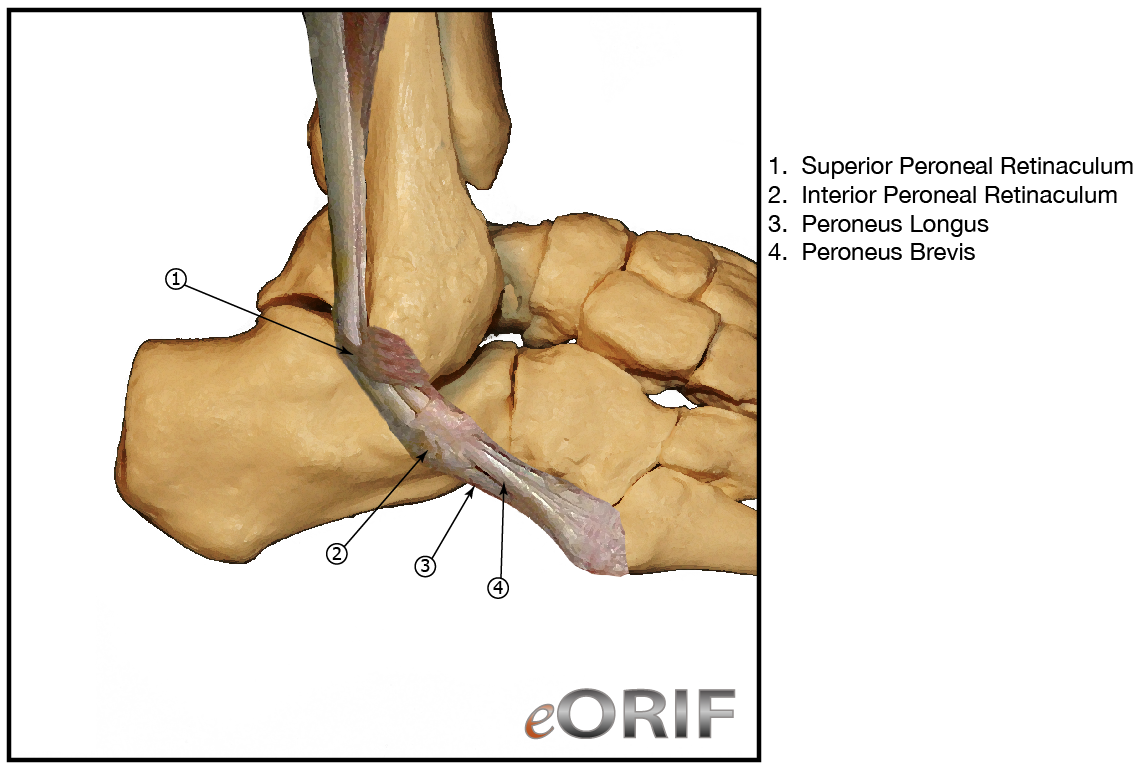 peroneal-tendon-tear-m66-88-727-69-eorif